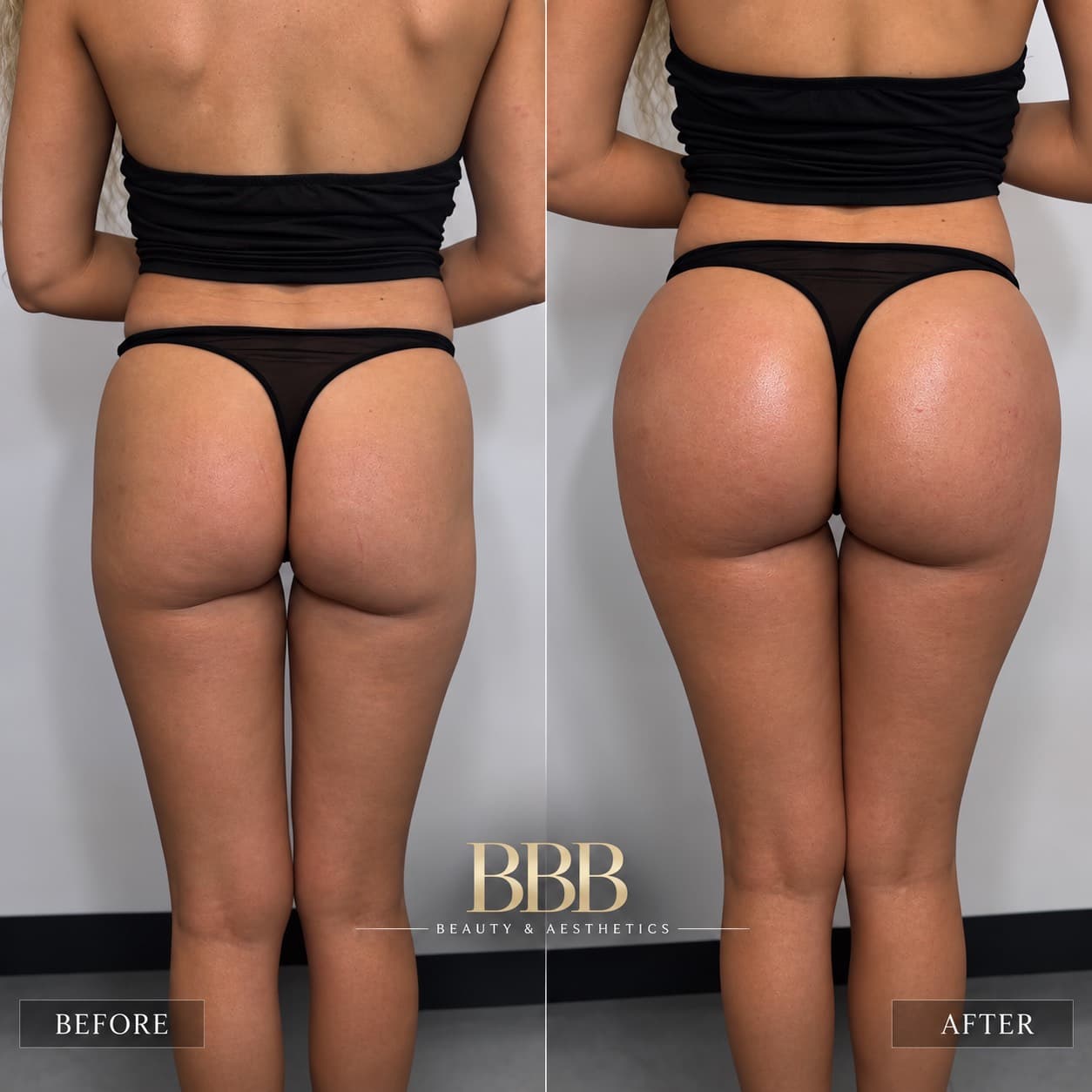 Before & after: BBL Filler