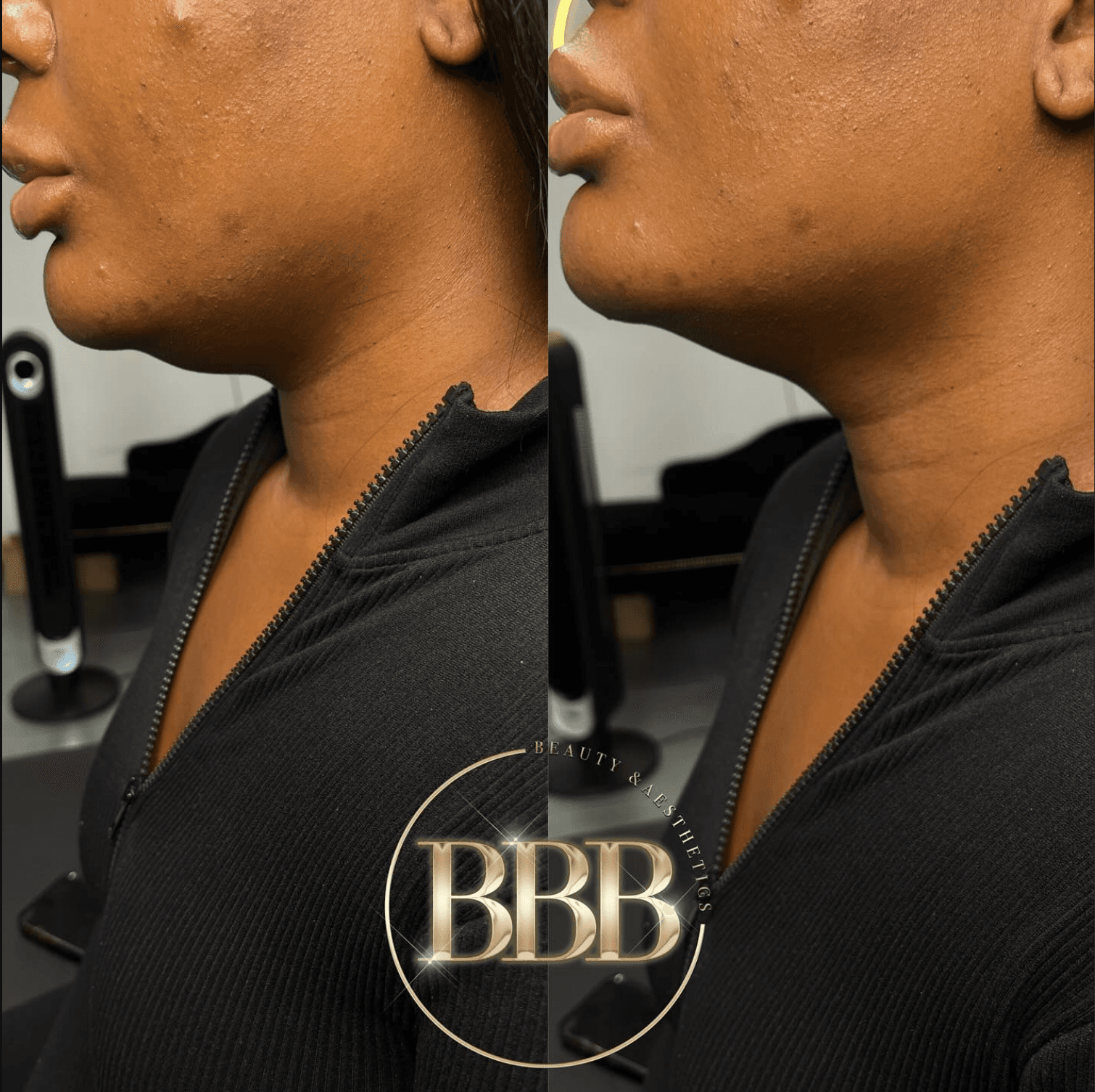 Before & after: Chin Filler