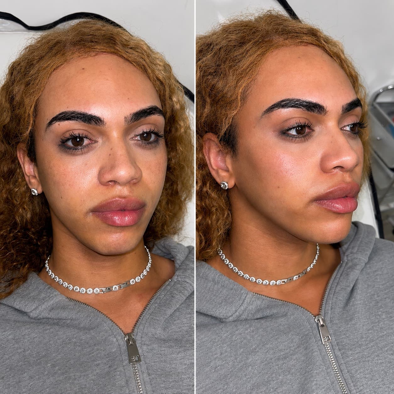 Before & after: Skin Boosters