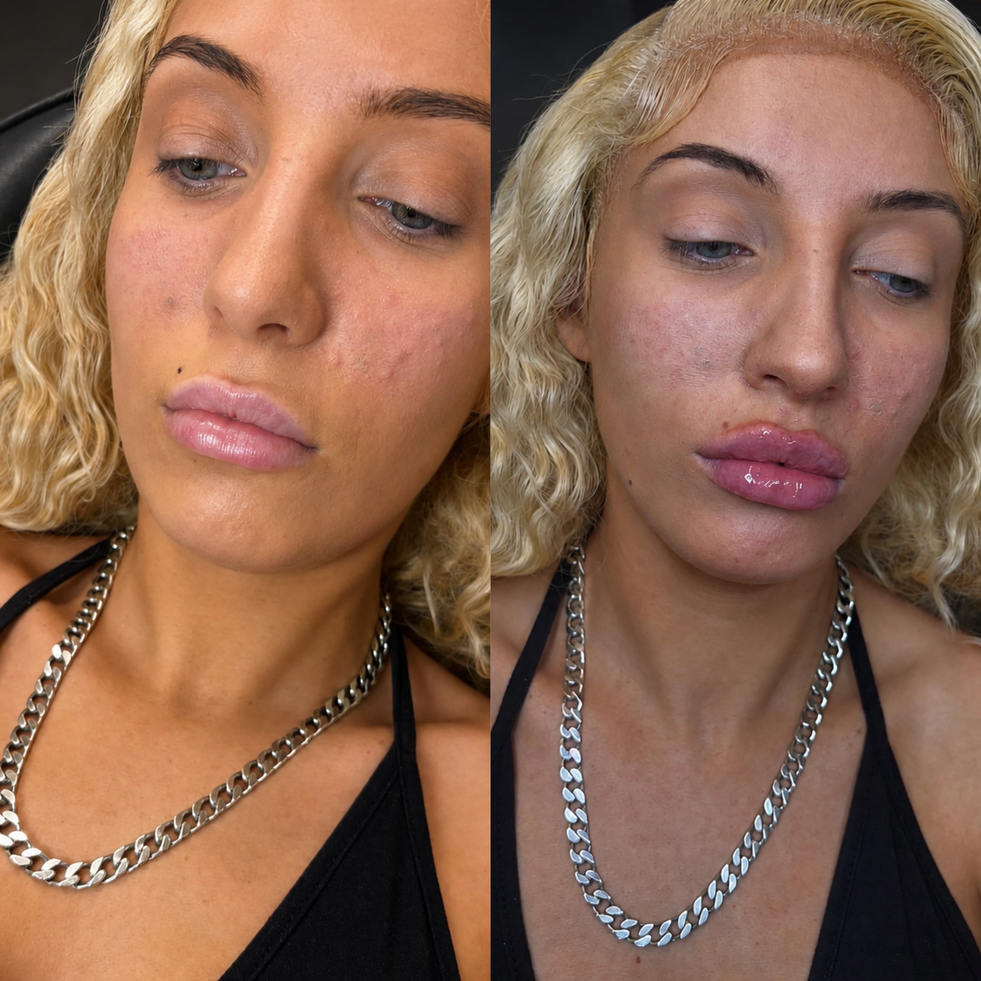 Before & after: Lip Filler